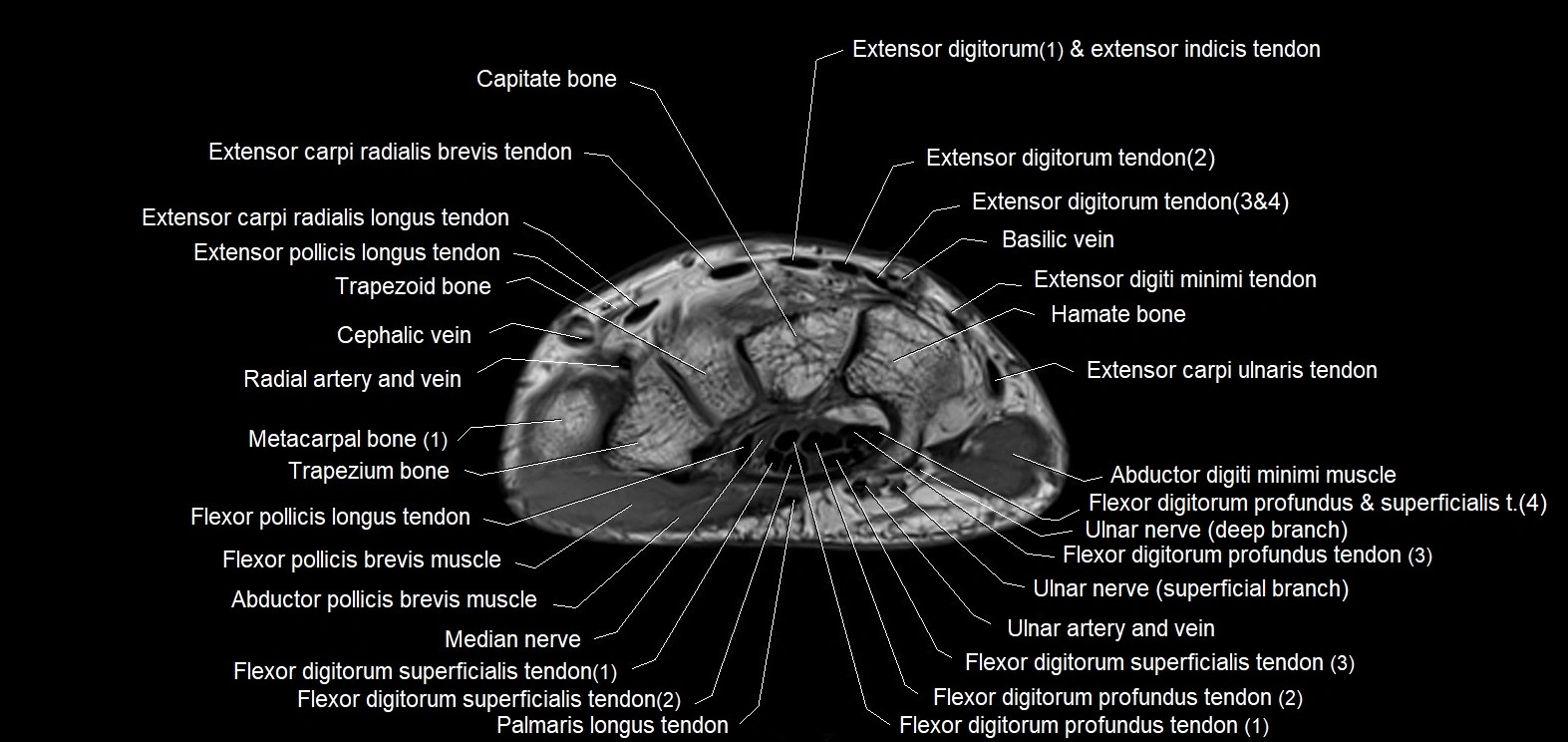 MRI 3T  hand axial labelled cross sectional anatomy imagemy  4.webp